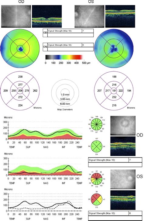 right eye macular thickness